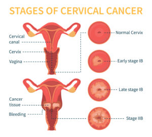 Stages of Cervical Cancer