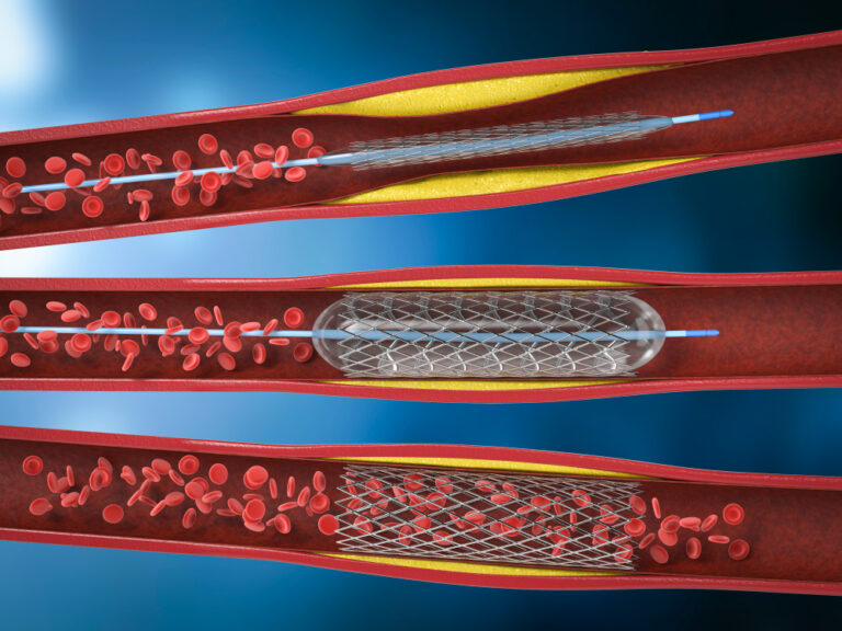 Angiography